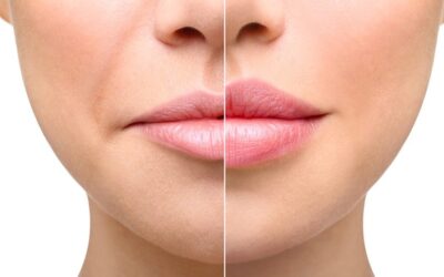 The Fascinating World of Dermal Fillers: 8 Common Questions for Injectors